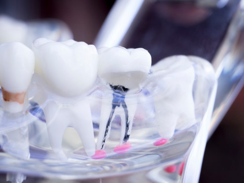 Root Canal Therapy